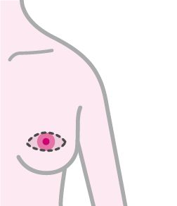 皮膚温存乳房切除術