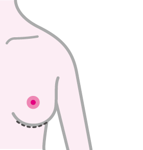 乳輪温存乳房切除術